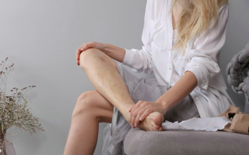 Understanding Varicose Veins and Compression Therapy